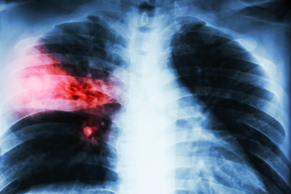 What Are the Symptoms and Stages of Lobar Pneumonia?