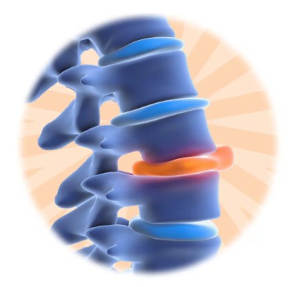 Understanding Herniated Discs: What They Are, Why They Happen & How to Find Relief